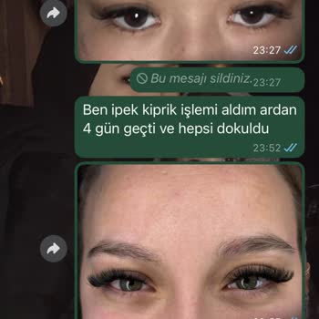 Göz Batması Ve Yamuk Tırnaklar: Hayal Kırıklığı