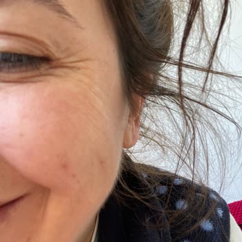 Botoks Ve Dolgu Hizmetinde Hayal Kırıklığı