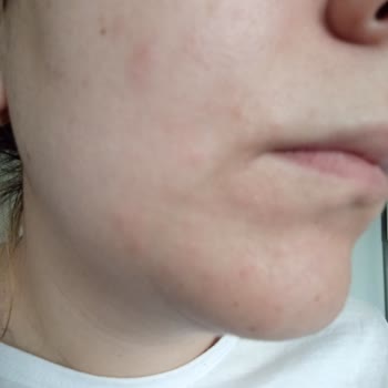 Koreaco Sarı Serum Yüzümü Mahvetti