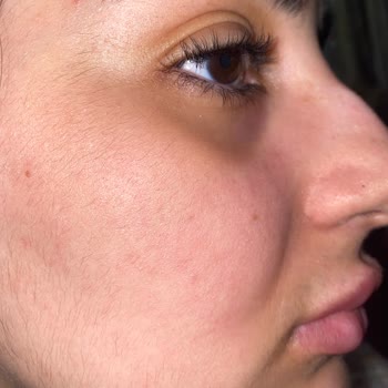Expigment Krem Yüzümde Leke Ve Yanma Sorunları Yarattı