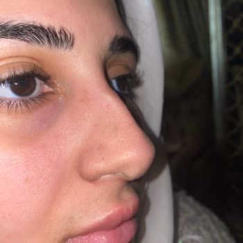 Expigment Krem Yüzümde Leke Ve Yanma Sorunları Yarattı