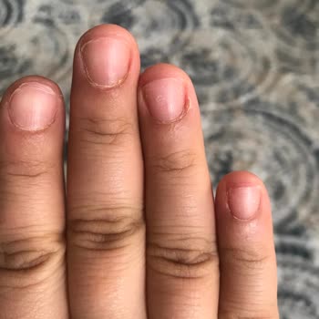 Manikür Sonrası İltihap Ve Dolama Sorunu