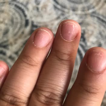 Manikür Sonrası İltihap Ve Dolama Sorunu