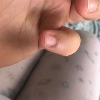 Manikür Sonrası İltihap Ve Dolama Sorunu