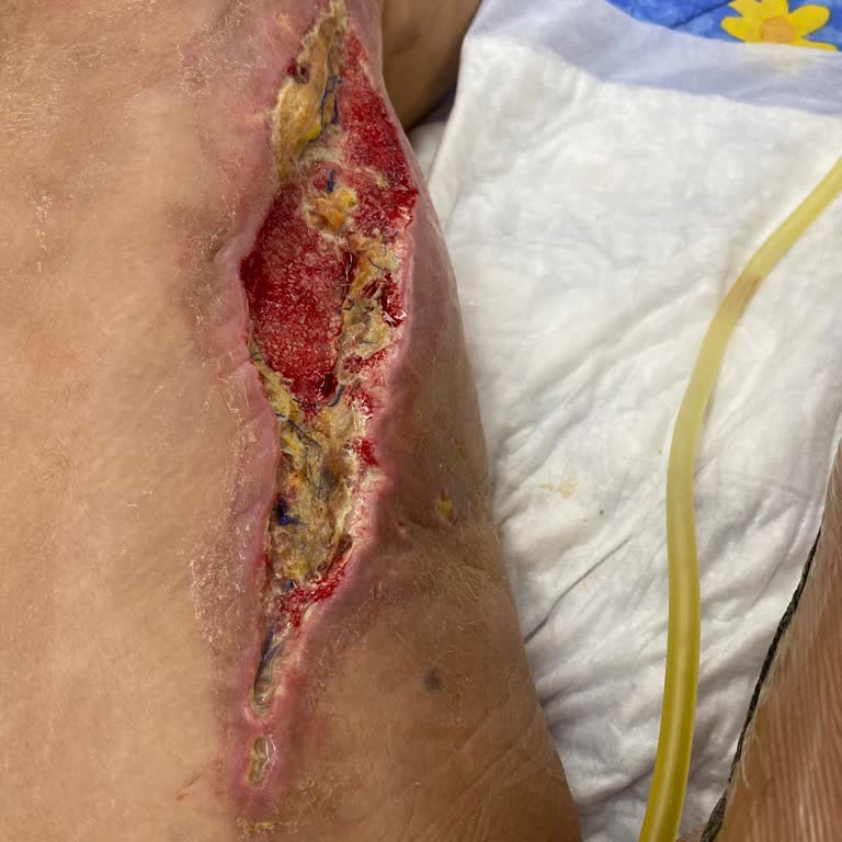 Ameliyat Sonrası Yaşadığım Kabus