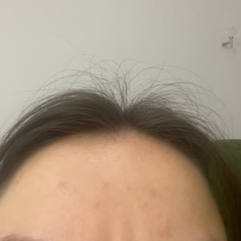 Bioderma Sebium Jel Kullanımı Sonrası Sivilce Problemi