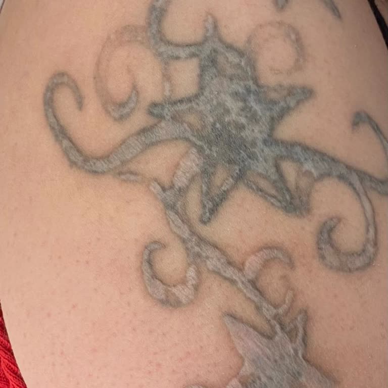 Dövme Sildirme Hizmetinde Yaşanan Sorunlar