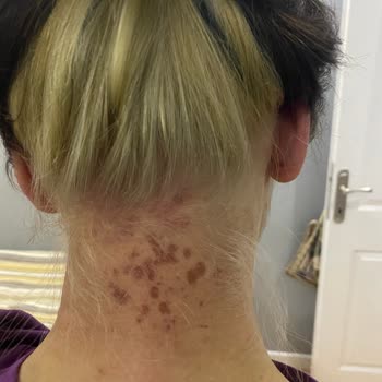 Saç Boyası Yanığı: Beklenmedik Tehlike