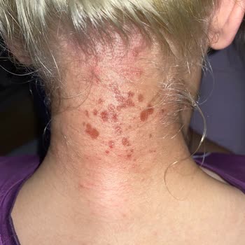 Saç Boyası Yanığı: Beklenmedik Tehlike