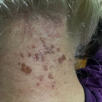 Saç Boyası Yanığı: Beklenmedik Tehlike