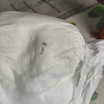 Bebek Bezi İçindeki Tehlikeli Yabancı Cisim