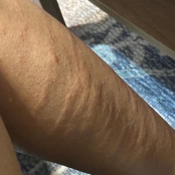 Lazer Epilasyon Sonrası Ciddi Yanıklar Ve İlgisizlik