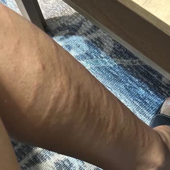 Lazer Epilasyon Sonrası Ciddi Yanıklar Ve İlgisizlik