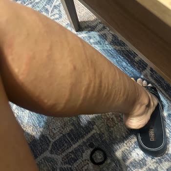 Lazer Epilasyon Sonrası Ciddi Yanıklar Ve İlgisizlik