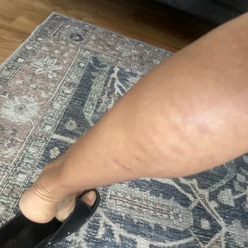 Lazer Epilasyon Sonrası Ciddi Yanıklar Ve İlgisizlik