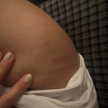 Lazer Epilasyon Sonrası Ciddi Yanıklar Ve İlgisizlik