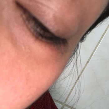 Göz Maskesi Alerjik Reaksiyon Yarattı