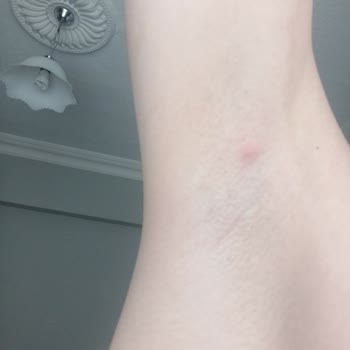 Rexona Deodorant Kullanımı Sonrası Ağrılı Bezeler Ve Cilt Sorunları