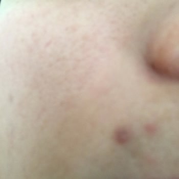 Epify Ürünü Cildimi Tahrip Etti, İade Garantisi Yalan