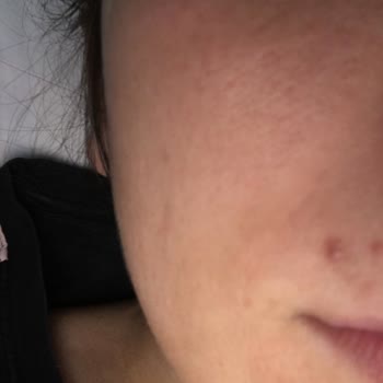 Epify Ürünü Cildimi Tahrip Etti, İade Garantisi Yalan