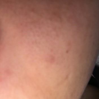 Epify Ürünü Cildimi Tahrip Etti, İade Garantisi Yalan