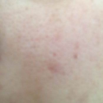 Epify Ürünü Cildimi Tahrip Etti, İade Garantisi Yalan