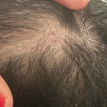 Saç Ekimi Hayal Kırıklığı: Yüksek Ücret, Düşük Hizmet