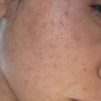 Manisa Ayşem Güzellik Salonu İğneli Epilasyon Sonucu Kalıcı İzler!