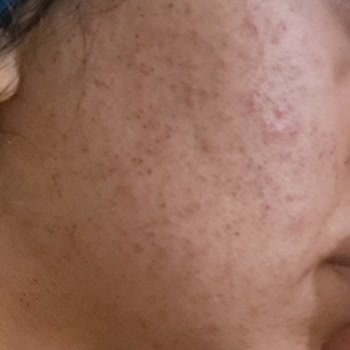 Manisa Ayşem Güzellik Salonu İğneli Epilasyon Sonucu Kalıcı İzler!