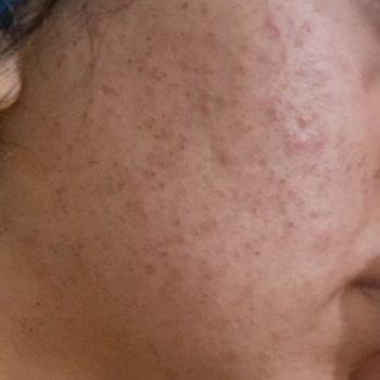 Manisa Ayşem Güzellik Salonu İğneli Epilasyon Sonucu Kalıcı İzler!