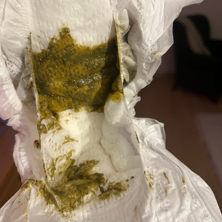 Milupa Aptamil Prosyneo Mama Deneyimi: Bebeklerde Gaz Sorunu Ve Olumsuz Etkiler