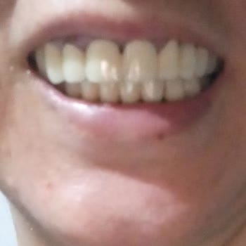 Yanlış Diş Tedavisi Mağduriyeti Ve Maddi Zarar