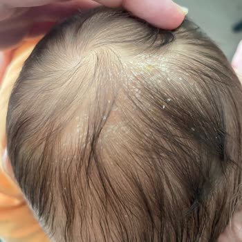 Bebeğimin Cildinde Kızarıklık Ve Konak Sorunu