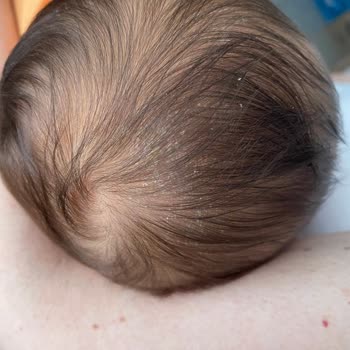 Bebeğimin Cildinde Kızarıklık Ve Konak Sorunu