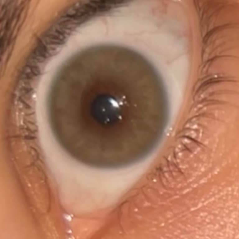 Kalitesiz Lensler Göz Sağlığımı Tehlikeye Atıyor