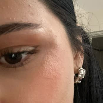 Loreal Paris Güneş Kremi Beklenmedik Cilt Reaksiyonu