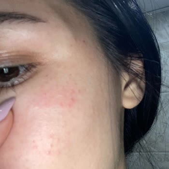 Loreal Paris Güneş Kremi Beklenmedik Cilt Reaksiyonu