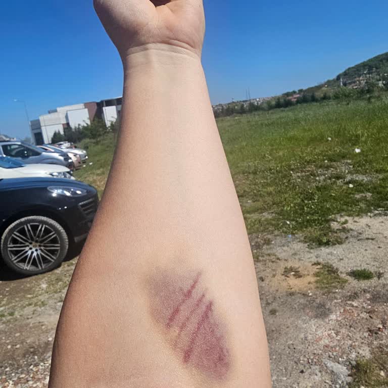 Serdivan Devlet Hastanesi Yanlış Yapılan İğne İşlemi Sonrası Kalıcı Hasar Riski