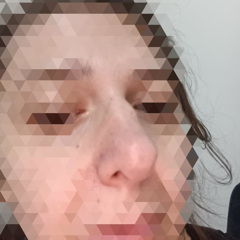 Yanlış Anlaşılan Burun Operasyonu Sonrası Hayal Kırıklığı