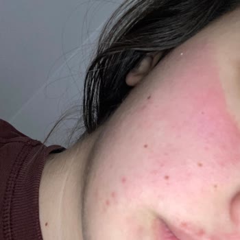 Bioderma Pigmentbio Serum Cildimi Yaktı