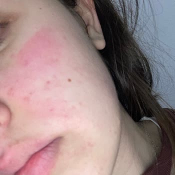 Bioderma Pigmentbio Serum Cildimi Yaktı