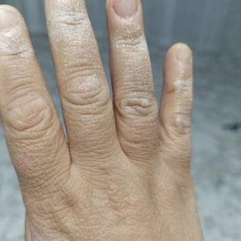 Vanish Kosla İle Cilt Yanması Tehlikesi