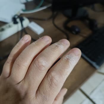 Vanish Kosla İle Cilt Yanması Tehlikesi