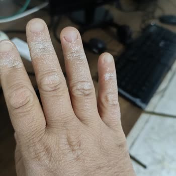 Vanish Kosla İle Cilt Yanması Tehlikesi