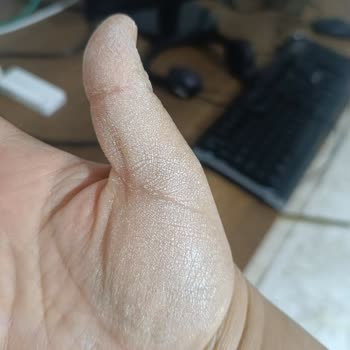 Vanish Kosla İle Cilt Yanması Tehlikesi