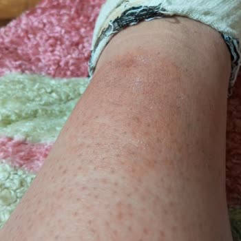 Lure Tüy Dökücü Şikayeti