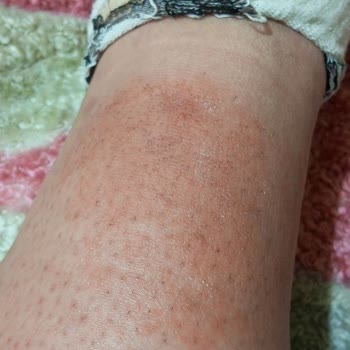 Tüy Dökücü Krem Sonrası Cilt Sorunları