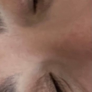 Bioderma Atoderm Krem Egzama Ve Tahrişe Sebep Oldu