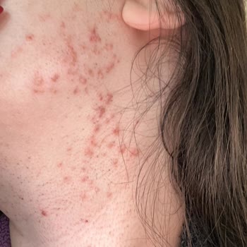 Epilasyon Sonrası Hayal Kırıklığı Ve Cilt Sorunları