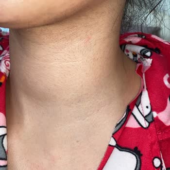 Lazer Epilasyon Seansları Hayal Kırıklığı Yarattı